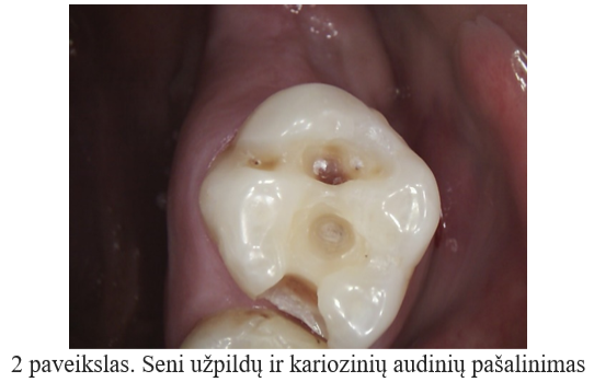Seni užpildai pašalinami dantų gydymo metu