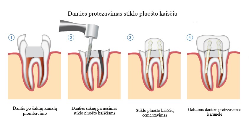 Stiklo pluošto kaištis dantų protezavimui