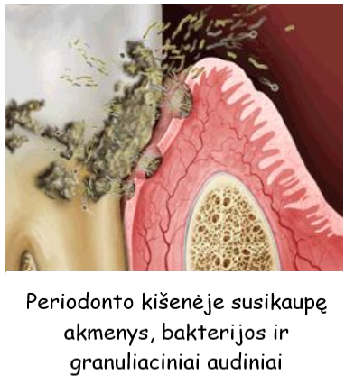 Kiuretažo procedūra dantenų gydymui