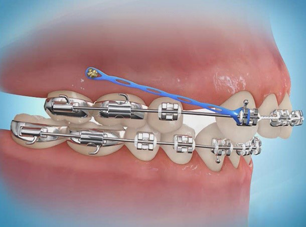 Ortodontinis implantas - titano sraigtas žandikaulyje