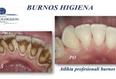 Burnos higiena