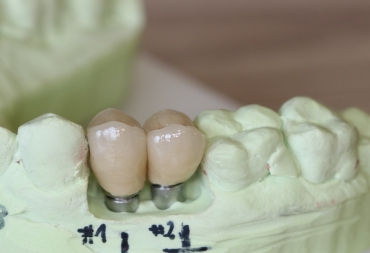 Klinikinio atvejo analizė: vienmomentinė implantacija viršutiniame žandikaulyje