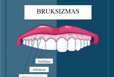 Bruksizmas (nudilusių dantų atstatymas)