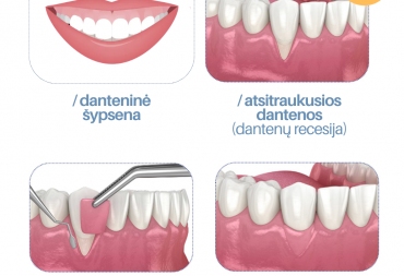 Dantenų plastika – kas tai ir kada reikalinga?