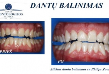 Dantų balinimas ZOOM sistema