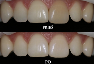 Endodontinis danties balinimas