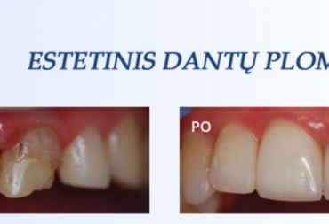 Estetinis dantų plombavimas