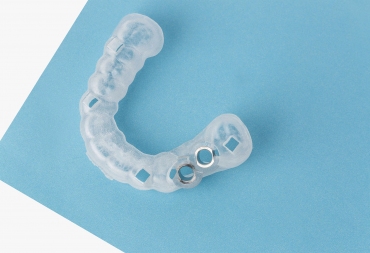 Gidinė implantacija: skaitmeninis planavimas, maksimalus tikslumas ir komfortas pacientui