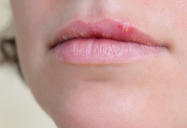 Herpes virusas