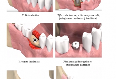 Implantavimo etapai