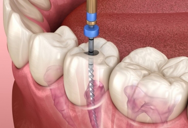 Kada dantį reikia gydyti endodontiškai, o kada pergydyti?