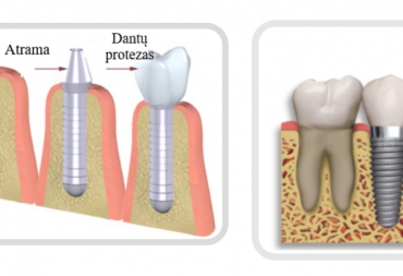 Kas yra dantų implantas?