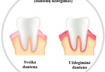 Kas yra Gingivitas?