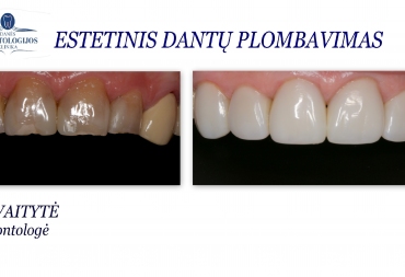 Klinikinio atvejo analizė: estetinis spalvą pakeitusių dantų plombavimas
