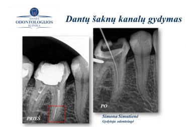 Klinikinio atvejo analizė: kanalų pergydymas