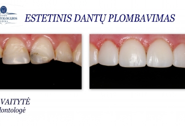 Kodėl verta rinktis estetinį dantų plombavimą?