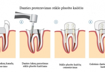 Protezavimas stiklo pluošto kaiščiu