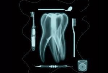 Rentgenologinis tyrimas endodontinio gydymo metu