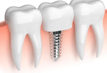 Vienmomentė implantacija: ką svarbu žinoti?