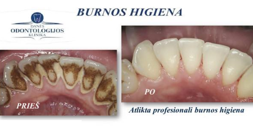 Burnos higiena