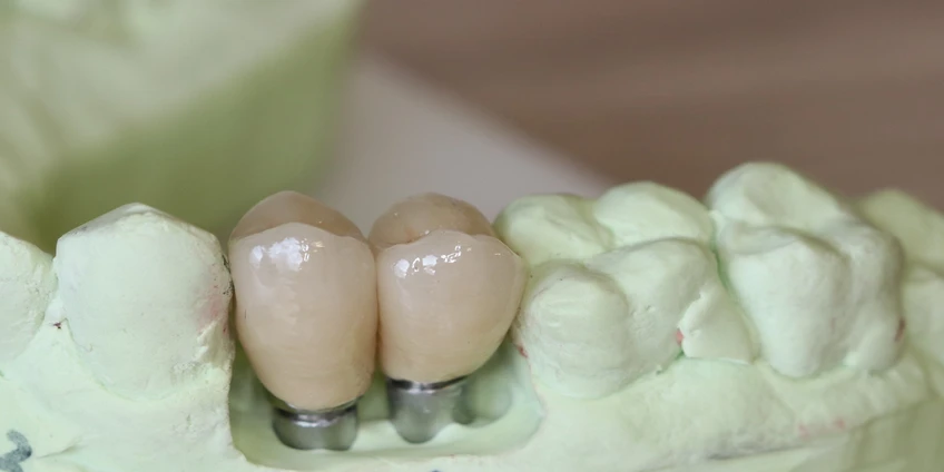 Klinikinio atvejo analizė: vienmomentinė implantacija viršutiniame žandikaulyje