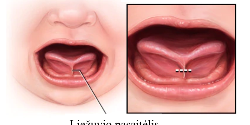 Lūpos, liežuvio pasaitėlio plastika