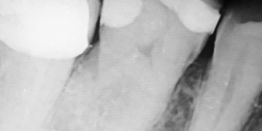  Dentalinė rentgeno nuotrauka (RVG)