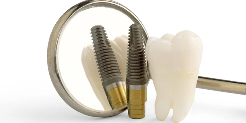 Rekomendacijos pacientams prieš ir po implantacijos procedūros