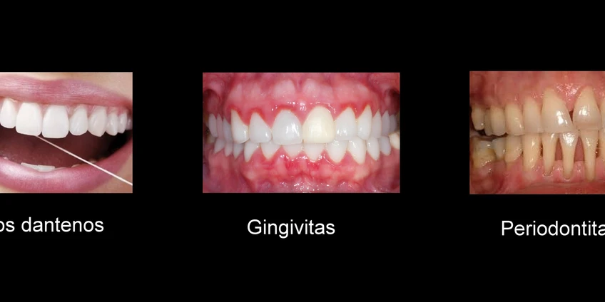 Periodonto ligos ir jų prevencija