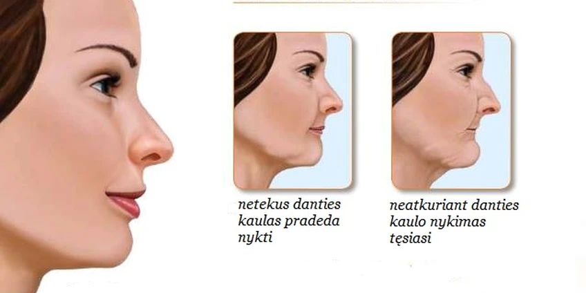 Kodėl svarbu atkurti prarastus dantis?