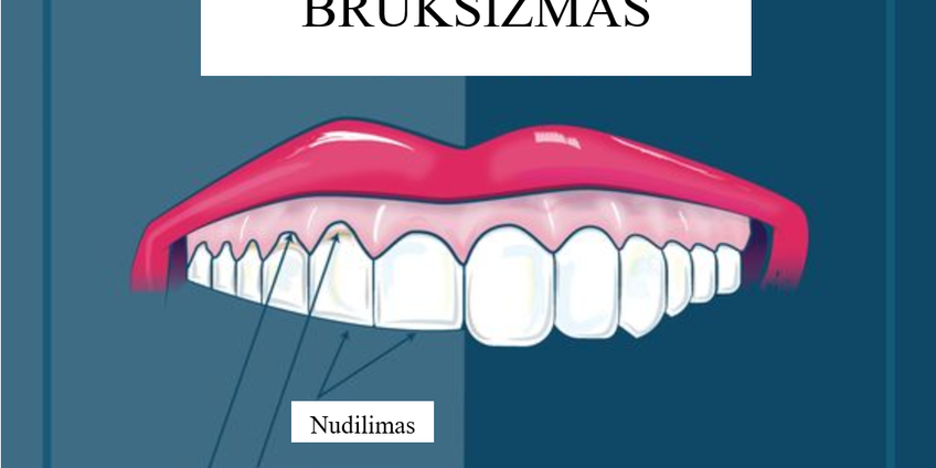 Bruksizmas (nudilusių dantų atstatymas)