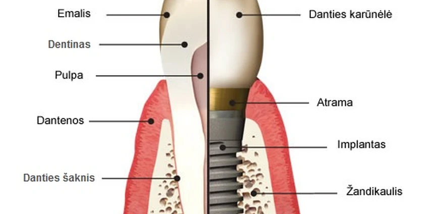 Dantų implantacijos privalumai