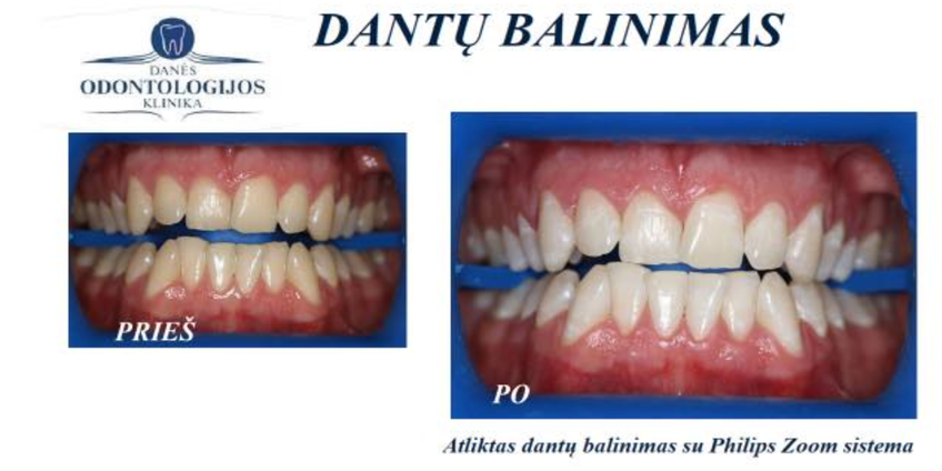 Dantų balinimas ZOOM sistema