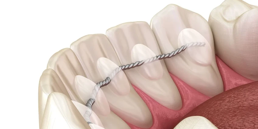 Dantų retencija po ortodontinio gydymo: kodėl ji būtina ir kokie metodai naudojami?