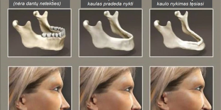 Žandikaulio kaulo nykimas po dantų netekimo 