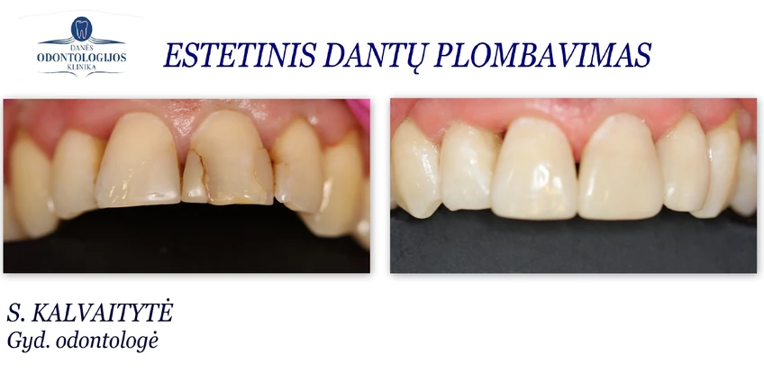 Dėl ko pakinta dantų spalva?