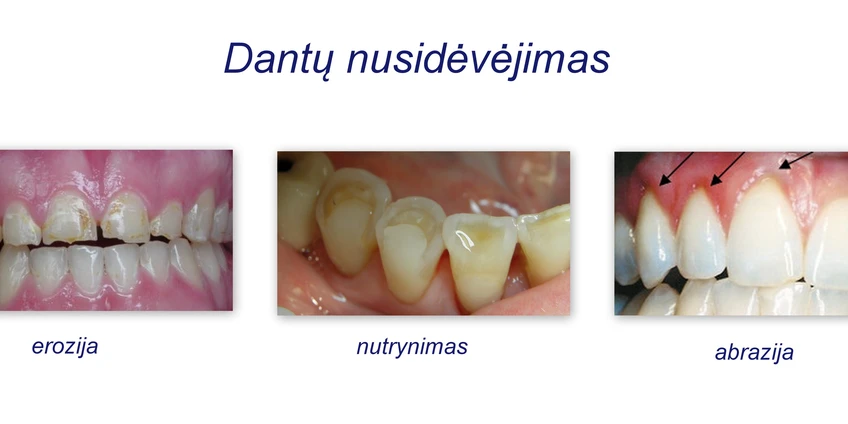 Dantų nusidėvėjimas ir jo gydymas