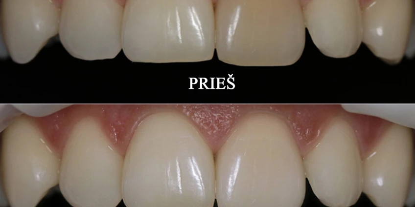 Endodontinis danties balinimas