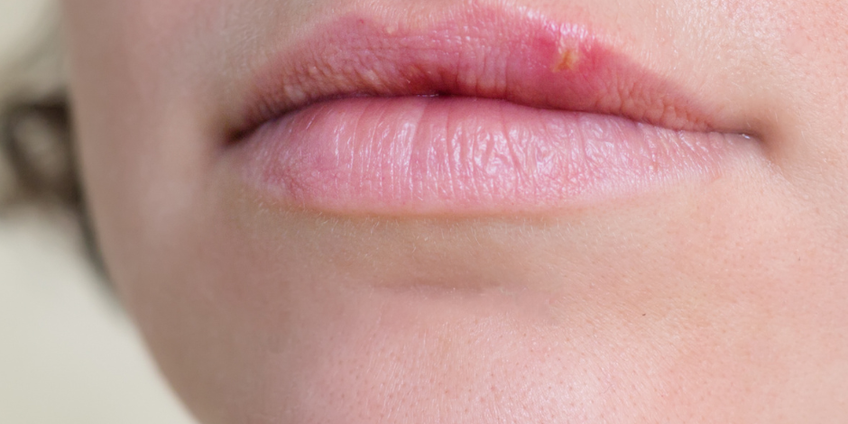 Herpes virusas