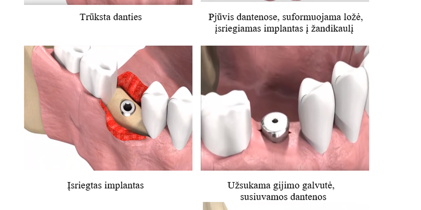 Implantavimo etapai