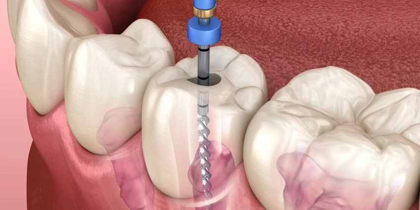 Kada dantį reikia gydyti endodontiškai, o kada pergydyti?