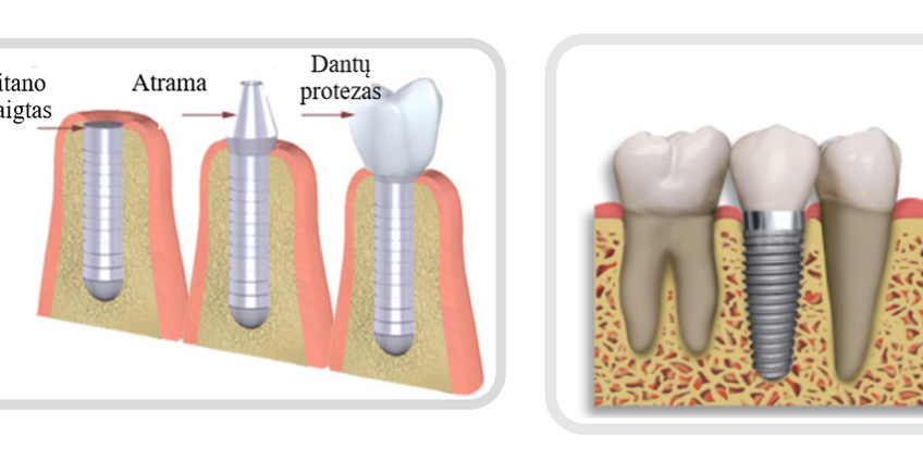 Kas yra dantų implantas?