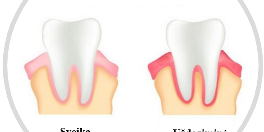 Kas yra Gingivitas?
