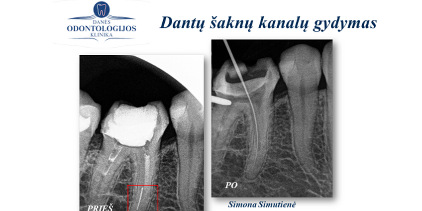 Klinikinio atvejo analizė: kanalų pergydymas