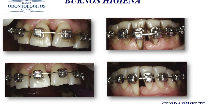 Klinikinio atvejo analizė: burnos higiena, nešiojant breketus