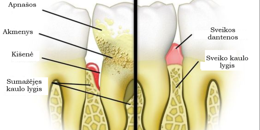 Periodontitas