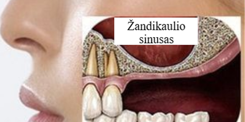 Sinuso dugno pakėlimo operacija