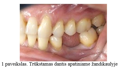 Trūkstamas dantis apatiniame žandikaulyje