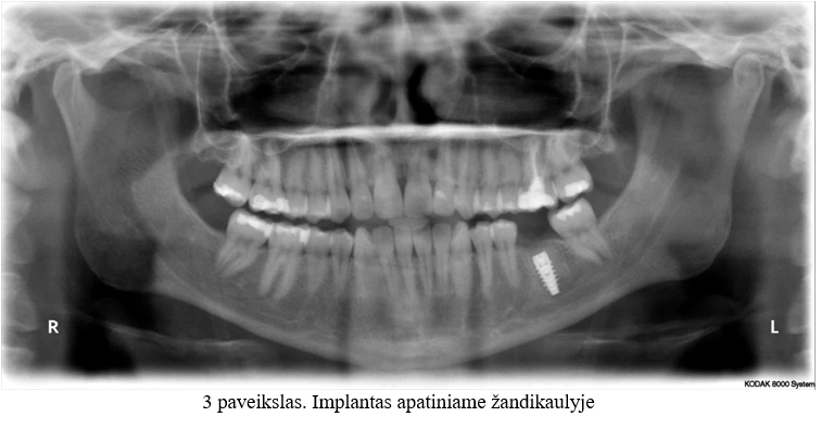 Implantas apatiniame žandikaulyje