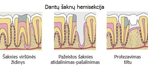 Dantų šaknų hemisekcija